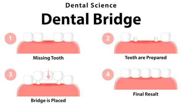 Infografica dell'essere umano nel ponte dentale su sfondo bianco