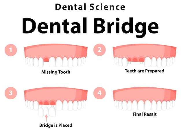 Free vector infographic of human in dental bridge on white background