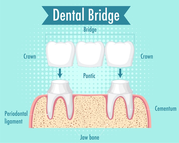 Infographic of human in dental bridge