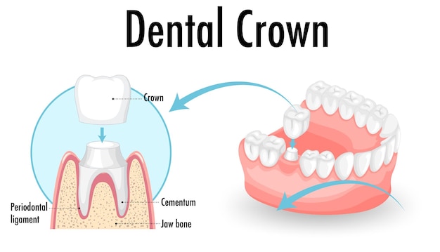 Infographic of human in dental crown
