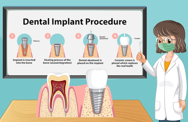 Vettore gratuito infografica dell'uomo nella procedura di impianto dentale