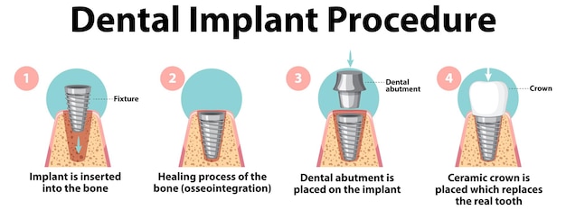 Vettore gratuito infografica dell'uomo nella procedura di impianto dentale