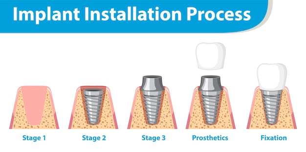 Free vector infographic of human in implant installation process