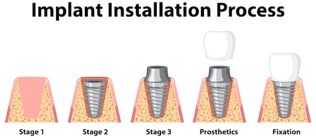 임플란트 설치 과정에서 인간의 인포 그래픽