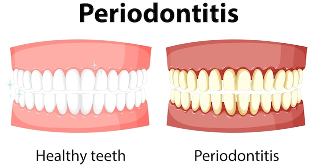 Infographic Of Human In Periodontitis