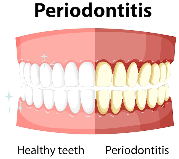 Vettore gratuito infografica dell'essere umano in parodontite