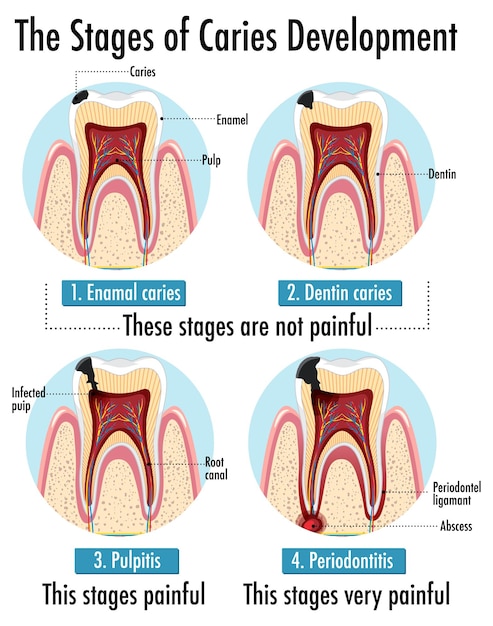 Free vector infographic of human in the stages of caries development