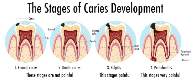 Инфографика человека на стадиях развития кариеса