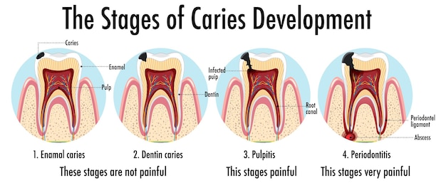 Infographic of human in the stages of caries development