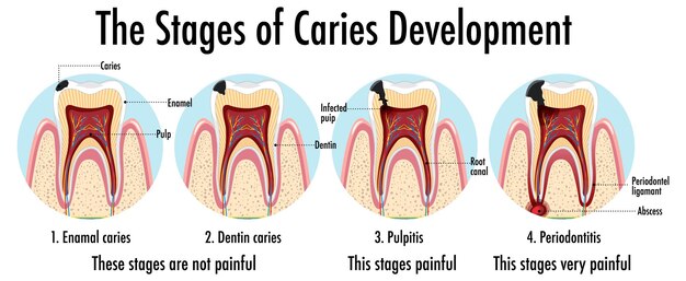 Infographic of human in the stages of caries development