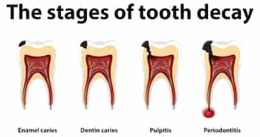 Free vector infographic of human in the stages of tooth decay