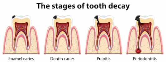 Free vector infographic of human in the stages of tooth decay