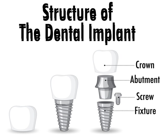 Infographic of human in structure of the dental implant