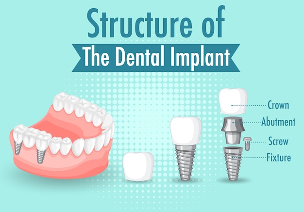 Free vector infographic of human in structure of the dental implant