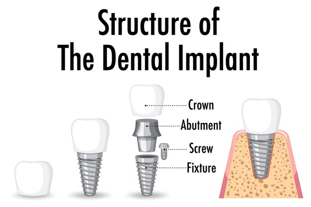 Infographic of human in structure of the dental implant