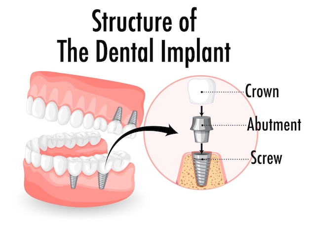 Infographic of human in structure of the dental implant