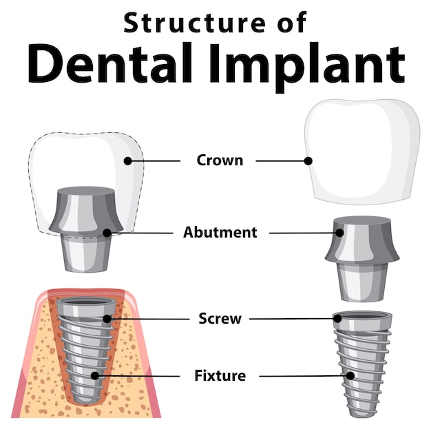 Free vector infographic of human in structure of the dental implant