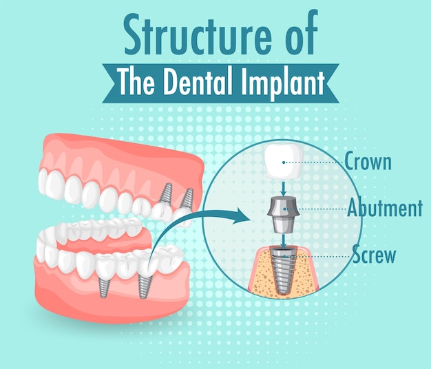 Инфографика человека в структуре зубного имплантата
