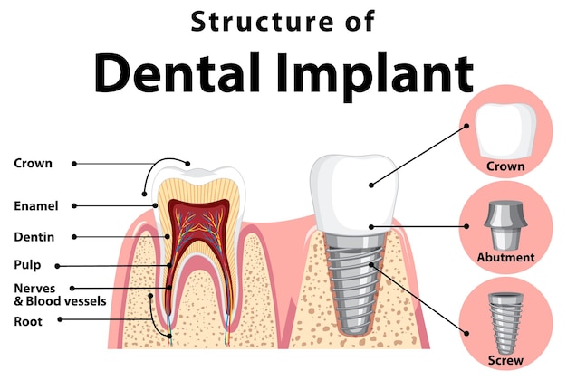 Free vector infographic of human in structure of the dental implant