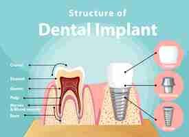 Free vector infographic of human in structure of the dental implant