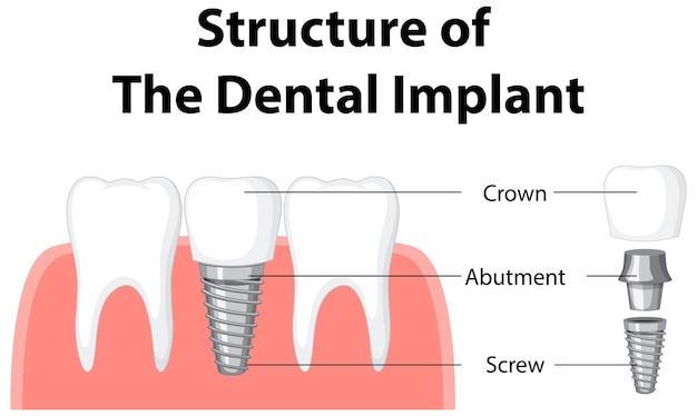 Infografica dell'essere umano nella struttura dell'impianto dentale