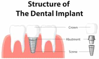 Free vector infographic of human in structure of the dental implant