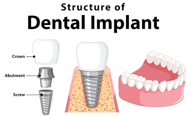 Infografica dell'essere umano nella struttura dell'impianto dentale