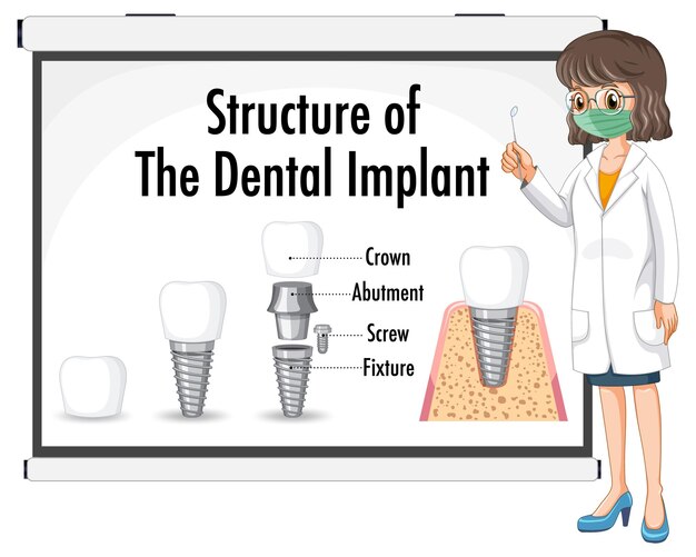 Infografica dell'essere umano nella struttura dell'impianto dentale