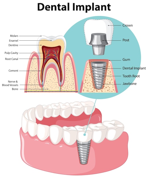 Free vector infographic of human in structure of the dental implant