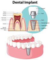 Infographic of human in structure of the dental implant