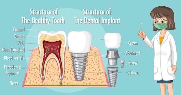 Free vector infographic of human in structure of the dental implant