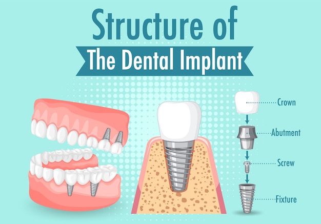 Vettore gratuito infografica dell'essere umano nella struttura dell'impianto dentale