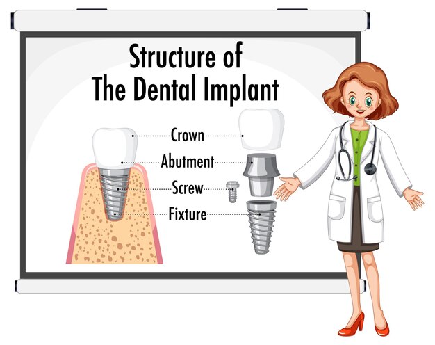 歯科インプラントの構造における人間のインフォグラフィック