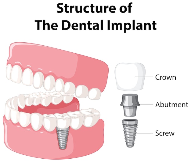 Инфографика человека в структуре зубного имплантата