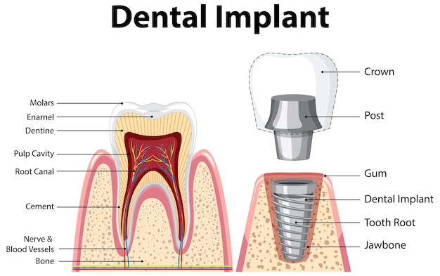 치과 임플란트의 구조에서 인간의 인포 그래픽
