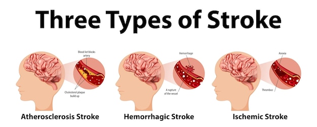 一般的なタイプの脳卒中のインフォグラフィック