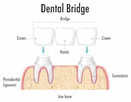 無料ベクター 白い背景の上の歯科用ブリッジの人間のインフォグラフィック