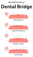 無料ベクター 歯科用ブリッジの人間のインフォグラフィック