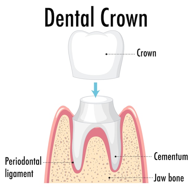 치과 크라운에 인간의 인포 그래픽