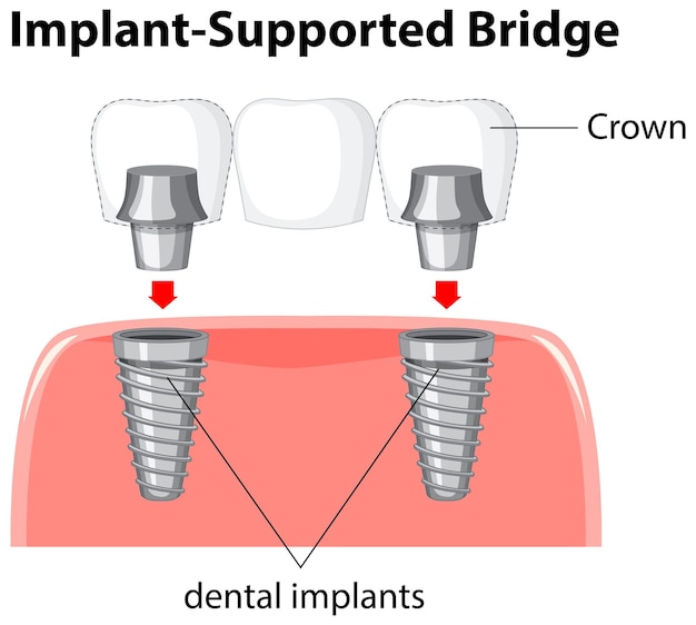 Инфографика человека в структуре зубного имплантата
