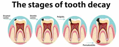 無料ベクター 虫歯の段階にある人間のインフォグラフィック