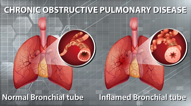 Free vector informative illustration of chronic obstructive pulmonary disease