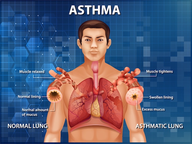 Illustrazione informativa del diagramma di asma di anatomia umana