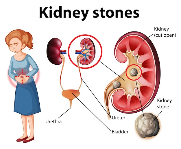 Informative illustration of kidney stones