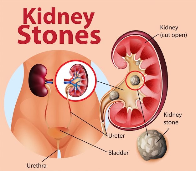 Free vector informative illustration of kidney stones