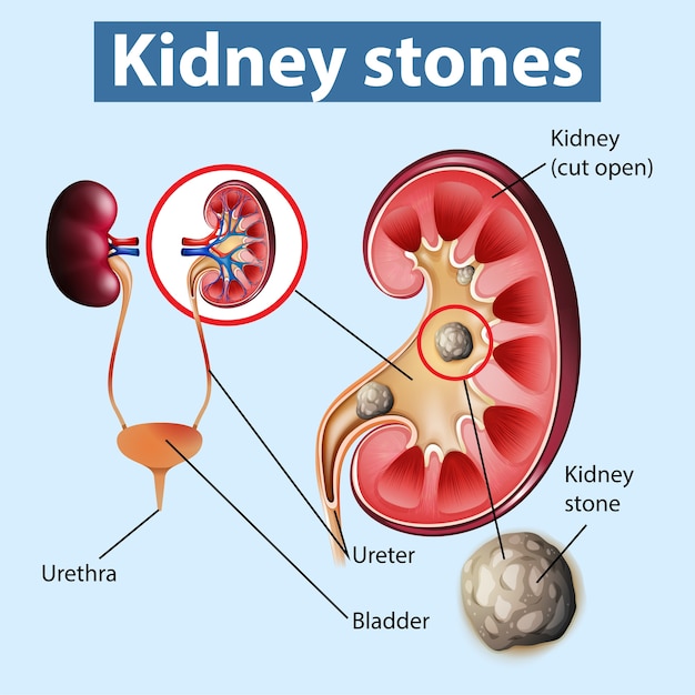 Free vector informative illustration of kidney stones