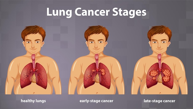 Vettore gratuito illustrazione informativa delle fasi del cancro del polmone