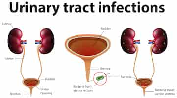 무료 벡터 요로 감염에 대한 유익한 그림