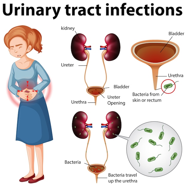 Бесплатное векторное изображение Информативная иллюстрация инфекций мочевыводящих путей