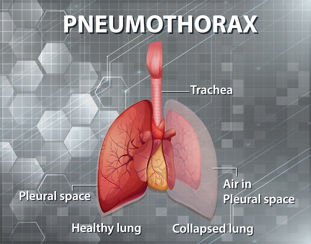 Informative illustration of pneumothorax